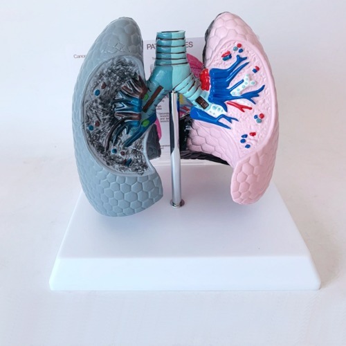인체 흡연 폐 비교모형R