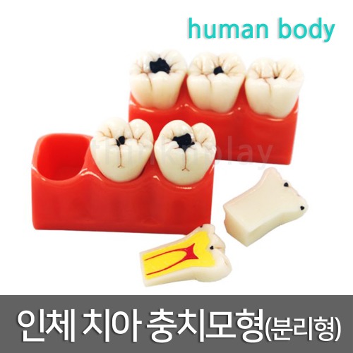인체 치아 충치 모형(분리형)R
